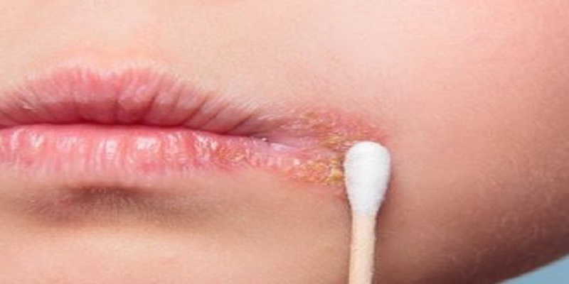 Nhiễm virus Herpes gây những vết phỏng rộp ở môi.