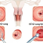 Ung thư cổ tử cung có thể chữa khỏi nếu phát hiện sớm.